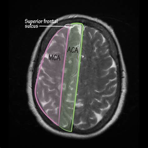 Neuroanatomy Glossary: Watershed (ACA/MCA) Stroke | ditki medical & biological sciences