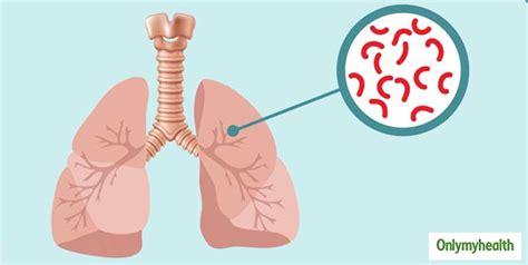 WHO New Recommendations To Prevent Tuberculosis In Hindi | कोरोना नहीं ...