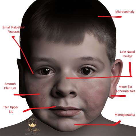 Fetal Alcohol Syndrome: Understanding its Causes, Symptoms, and Prevention | The Ridge Ohio ...
