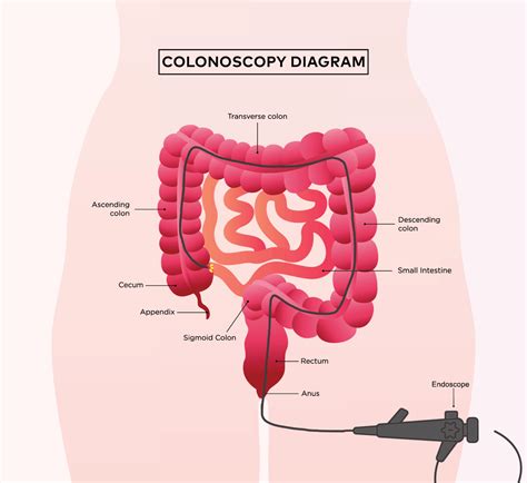 Image result for Colonoscopy Colitis