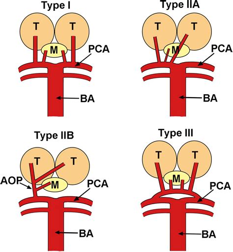 Frontiers | Case report: Artery of Percheron infarction as a rare complication during atrial ...