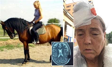 Gra, 59, was left with shattered plastic shunts in her head