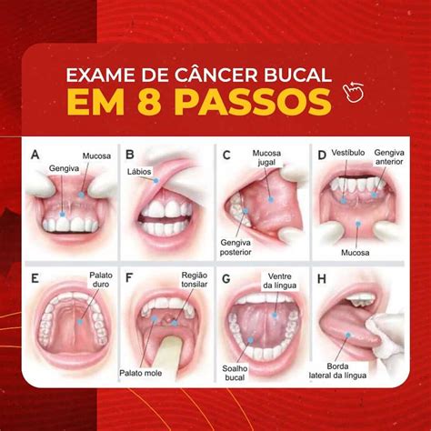 Diagnóstico do Câncer de Boca e Orofaringe – Aspec Solídaria