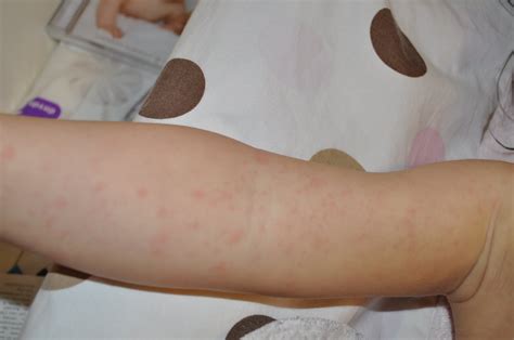 Baby Rash Pictures, Causes, Treatments - Mommyhood101