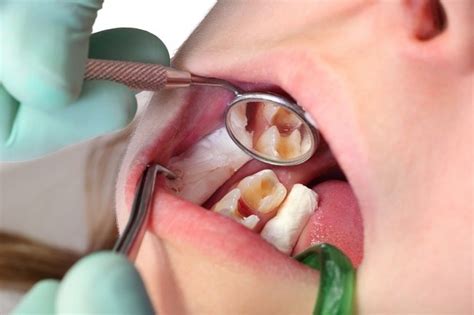 Gigi Keropos - Gejala, Penyebab, dan Pengobatan - Alodokter