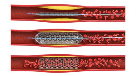 Stents | Victor Chang Cardiac Research Institute