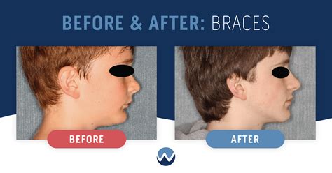 Before & After Braces: See the Amazing Results Yourself! • Woodhill Dental Specialties ...
