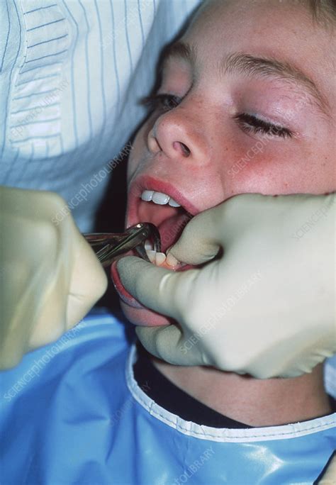 Image result for Tooth Extraction HD Images