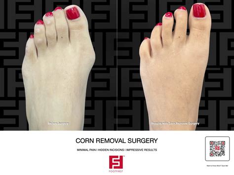 Minimally Invasive Corn Removal Surgery at Foot First Podiatry — Foot First Podiatry Centers