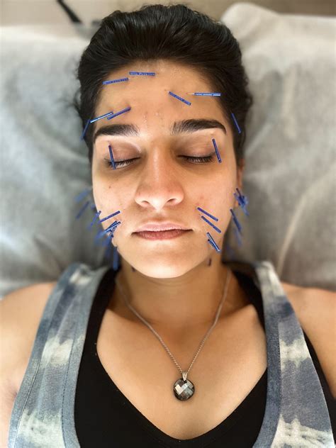 Acupuncture 的图像结果