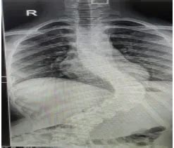 Successful Scoliosis Correction with Neuromonitoring