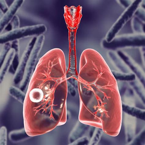 Tuberculosis: Transmission and Treatment