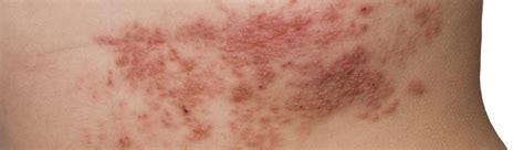 What are Shingles? (With Pictures) -HealthScope