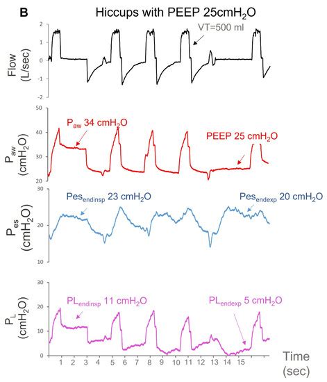 Hiccup-like Contractions in Mechanically Ventilated Patients ...