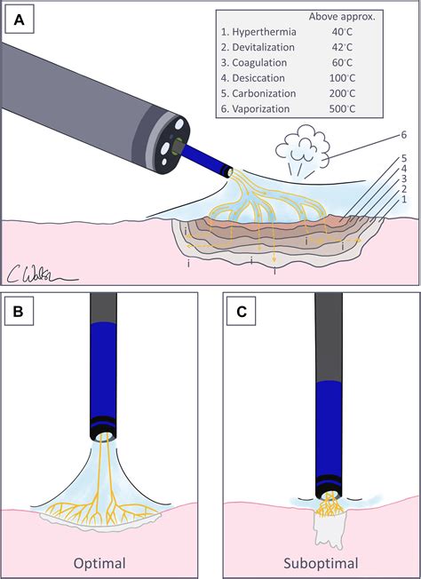 Gastrointestinal Bleeding in Children - Gastrointestinal Endoscopy Clinics
