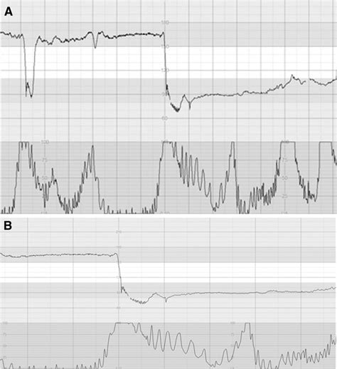 Pathophysiological interpretation of fetal heart rate tracings in clinical practice - American ...