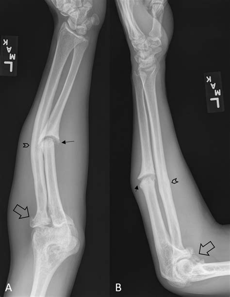 Ulna Bone Fracture
