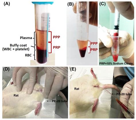 Therapeutic Effect of Platelet-Rich Plasma Improves Bladder ...