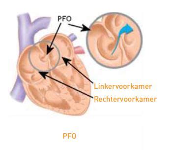 PFO Defect 的图像结果