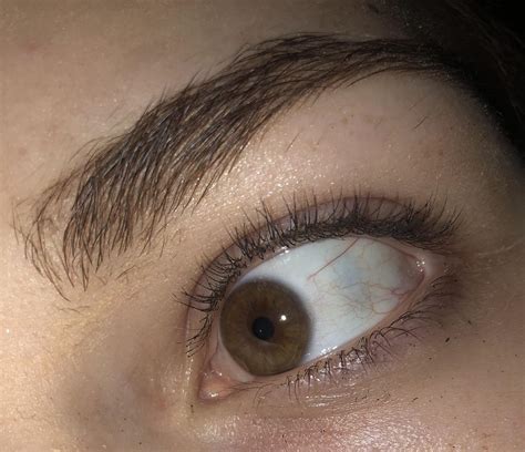 What does this dark spot in the whites of my eye mean? : medical