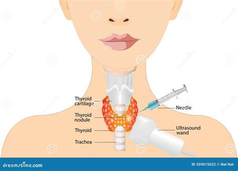 Fine Needle Aspiration Biopsy of the Thyroid Gland in a Patient Using ...