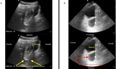 Focused Assessment with Sonography for Trauma (FAST) Exam: Image ...