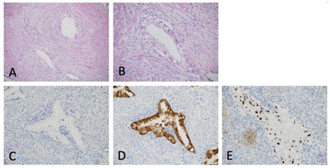 Gastric-Type Adenocarcinoma of the Uterine Cervix Associated with Poor ...