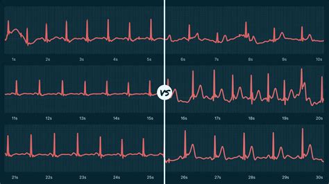 Sinus Arrhythmia Vs. Atrial Fibrillation on Your Watch ECG | Qaly