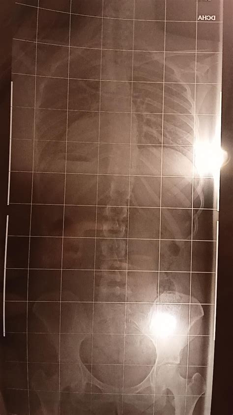 hi fellow twisted friends : r/scoliosis