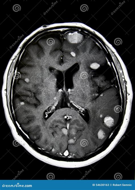 What Does Cancer In The Brain Look Like On An Mri at Carolyn Daniels blog