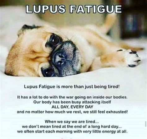 lupus fatigue