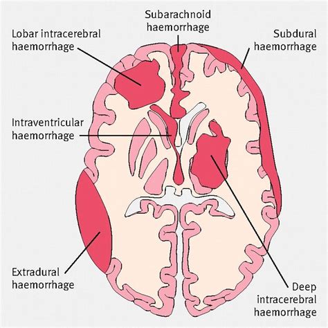 Iph Medical Abbreviation