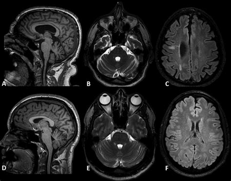 Processing speed impairment in chronic inflammatory demyelinating ...