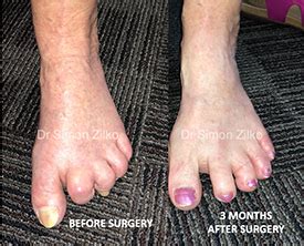 Image result for Toe Surgery