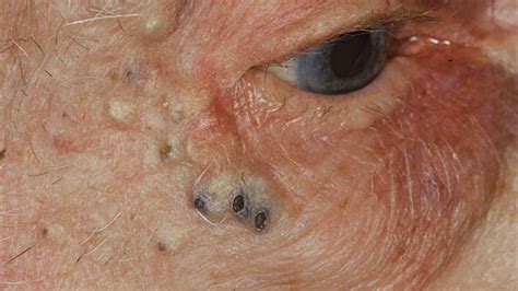 Image result for Solar Comedones Extraction