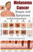 Image result for Stage 4 Melanoma Cancer