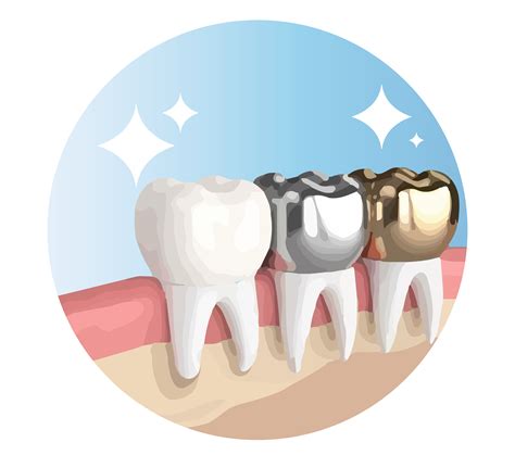 Illustration of a row of teeth showcasing various dental crown materials, including gold, silver ...
