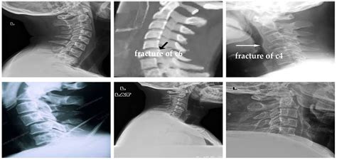 Classification of Cervical Spine Fracture and Dislocation Using Refined Pre-Trained Deep Model ...