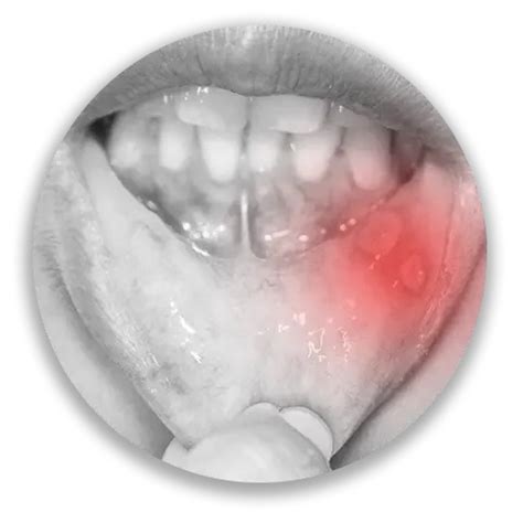 Orasore Mouth Ulcer Tablet | Effective Relief for Mouth Ulcers – Health ...