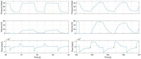 Incomplete Exhalation during Resuscitation—Theoretical Review and ...