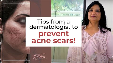 Tips from a Dermatologist to Prevent Acne Scars!
