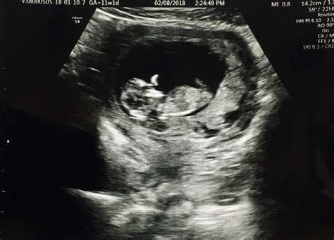Our baby waved at us during our second ultrasound at 11 weeks and 1 day ...