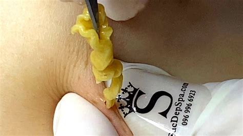 Exploding Pimples 2018 的图像结果