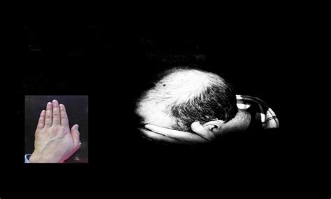 Men Whose Ring Finger Is Bigger Than Index Are Likely To End Up Bald ...