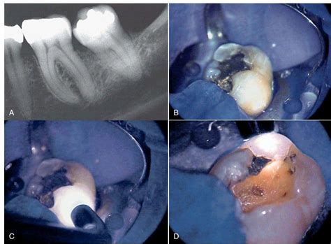 Image result for Transillumination Normal Head