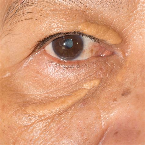 Yellow Areas on Eyelids (Xanthelasma) | Faciem Dermatology & Medical Clinic