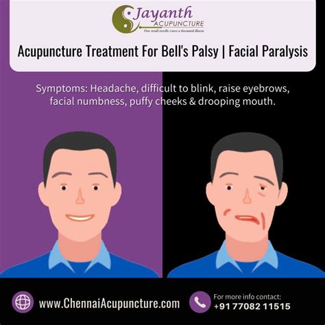 Acupuncture Treatment For Bell's Palsy | Facial Paralysis - ChennaiBest Acupuncture Treatment by ...