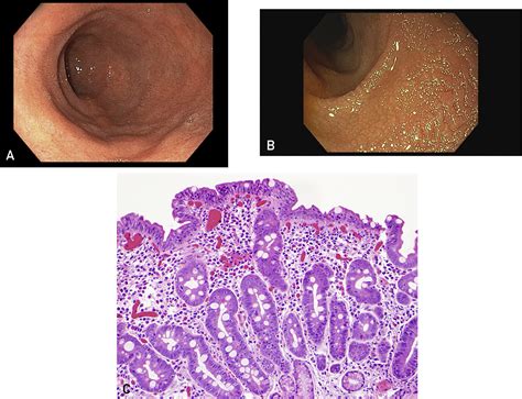 Celiac Disease - Mayo Clinic Proceedings