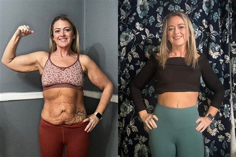 Addy's Sono Bello Transformation | Charleston Loose Skin Removal