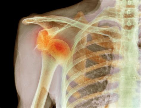 Signs Of Dislocation Shoulder at Nate Piquet blog